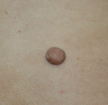 Опухоль из соединительной ткани