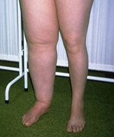 Отек правой ноги